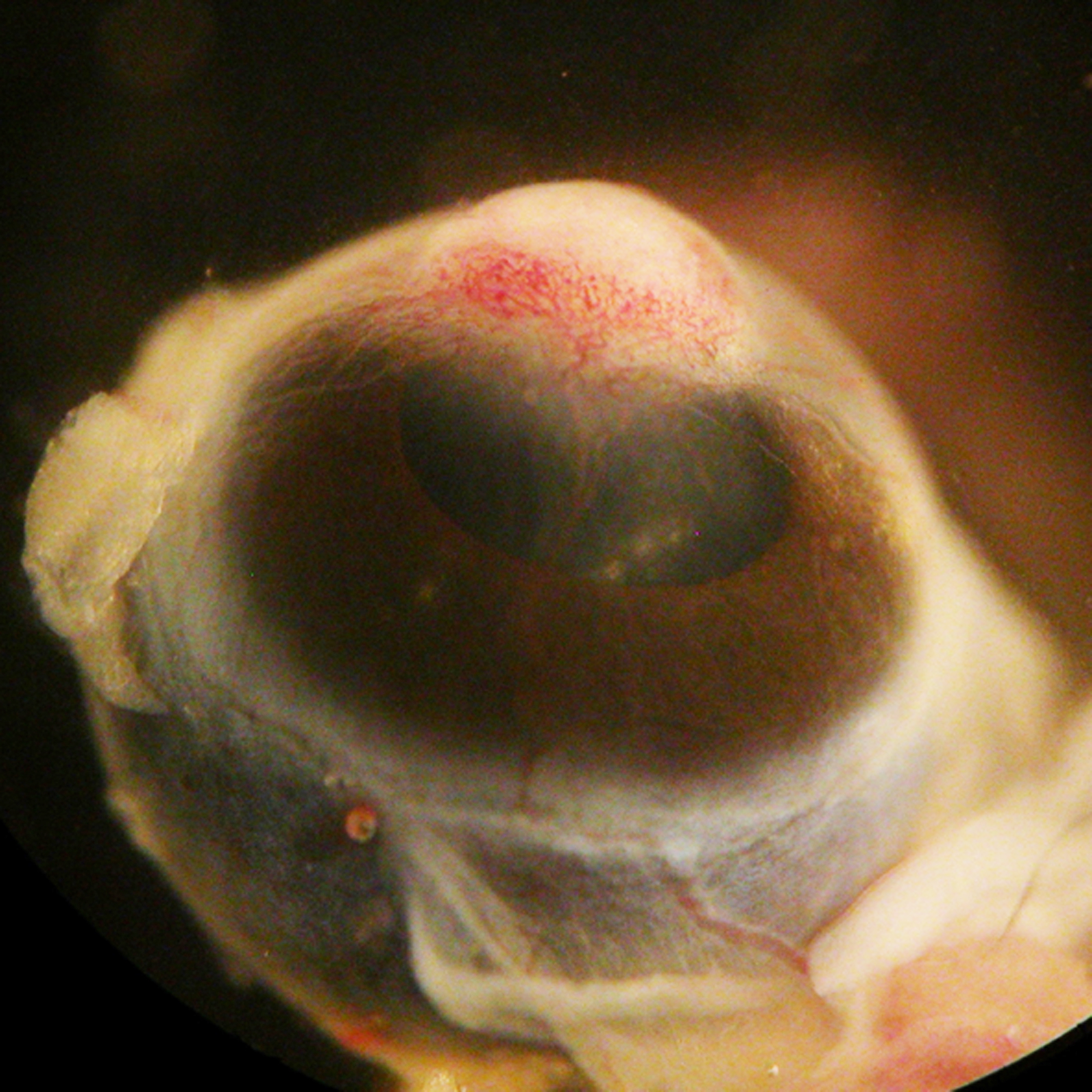 Metaplastic_cornea_hr